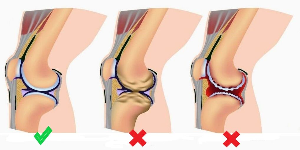 Depanten prevents the development of arthritis and osteoarthritis