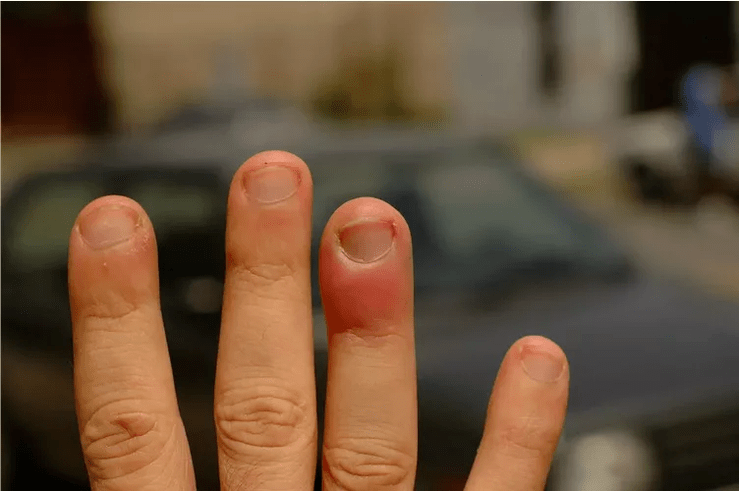 Periungual panaritium, causing pain in the finger joints