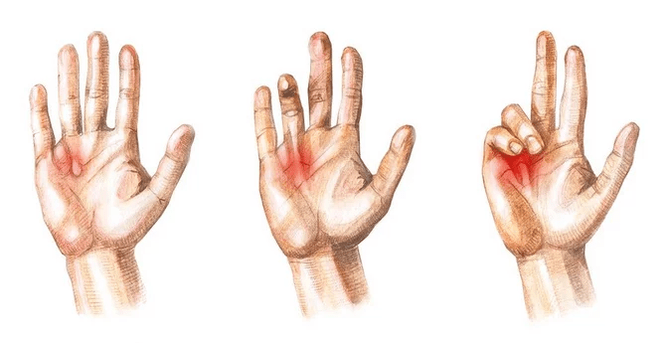 Stages of Dupuytren's disease - inability to straighten fingers