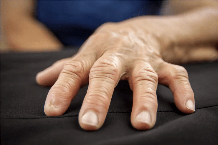 With gout, the knuckles become warm to the touch, swollen and painful. 