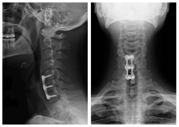 Image after treatment of vertebrae