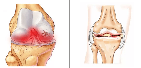 Comparison of arthritis osteoarthritis