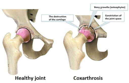 Healthy joint affected by joint coksartrosis