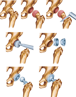 Installation of endoproshese