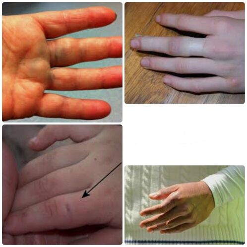 Bruises and fractures of the fingers are characterized by pain and swelling of the joints.
