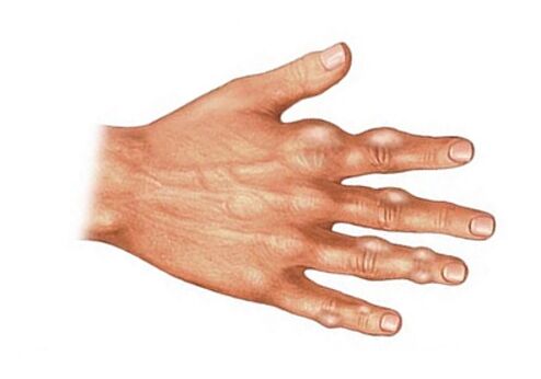 Deposition of uric acid crystals in soft tissues during gout