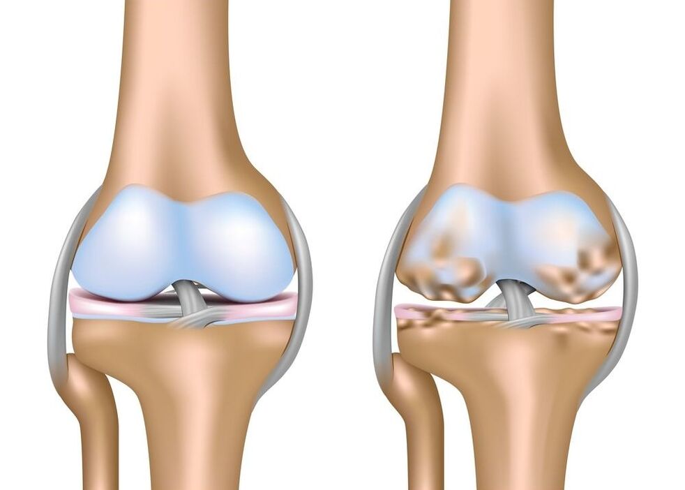 exacerbation of osteoarthritis of the joints