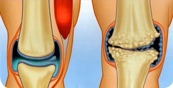 healthy joint and arthrosis of the joint