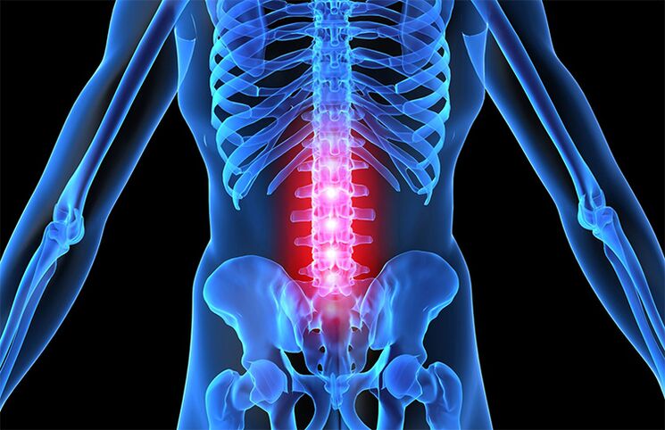 lumbar spine osteochondrosis