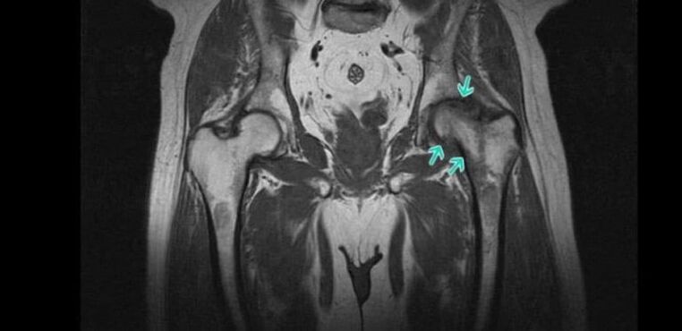 Hip osteoarthritis on MRI