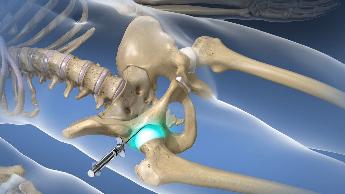 Intra-articular blockade for severe pain accompanying osteoarthritis of the hip