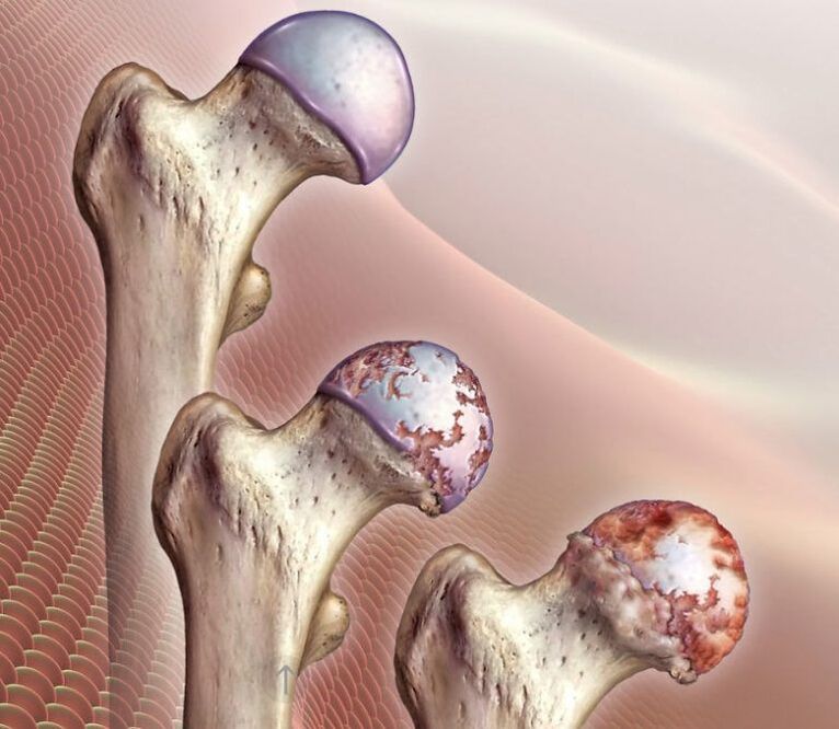 Osteoarthritis of the hip joint in varying degrees