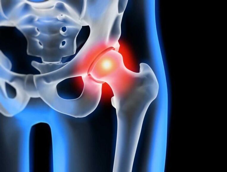 Osteoarthritis of the hip joint