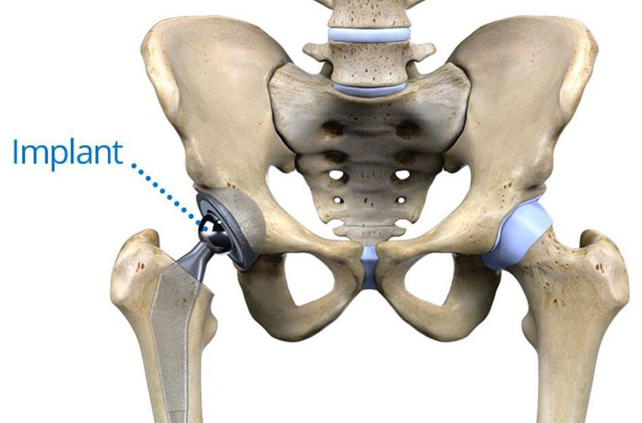 Total hip prosthesis for osteoarthritis