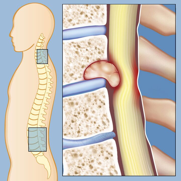 Malignant tumor as a cause of severe lower back pain